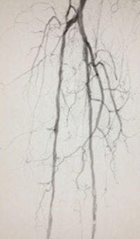 Case CLI with Right Foot Ulcer Thrombectomy post-AngioJet Solent Dista.