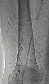 Thrombectomy of Occluded SFA - pre-procedure