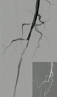 Thrombectomy of Occluded SFA - catheter positioning