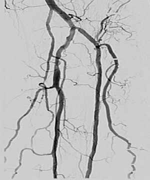 Proven in calcified arteries.