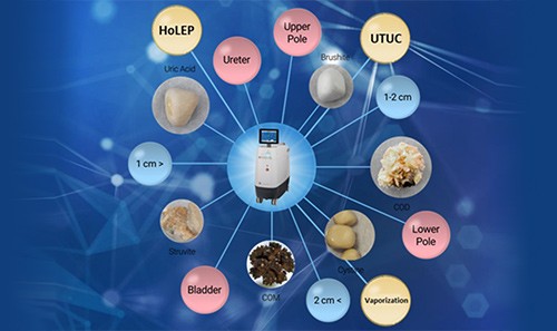 ホルミウムレーザー