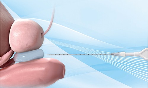 Prostate Cancer 前立腺がん（放射線治療）