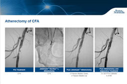 Femoral Comum