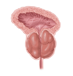 Próstata agrandada