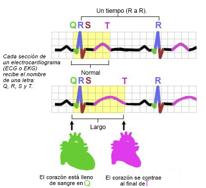 Ilustración del síndrome del QT largo