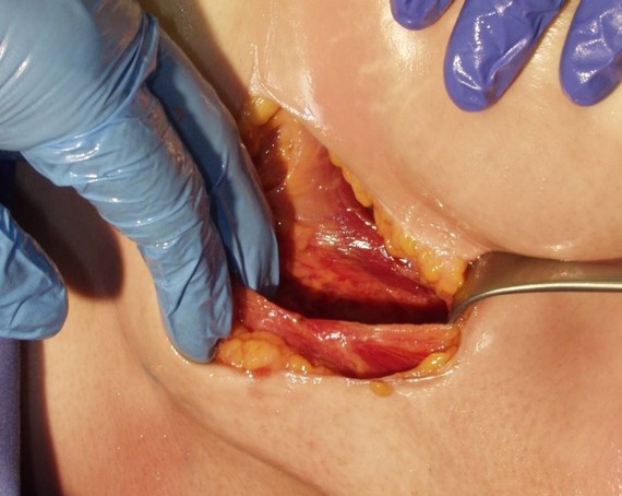 Intermuscular technique image 1