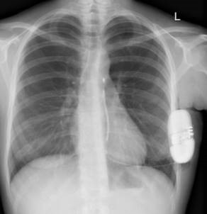 Optimal Front View S-ICD Placement