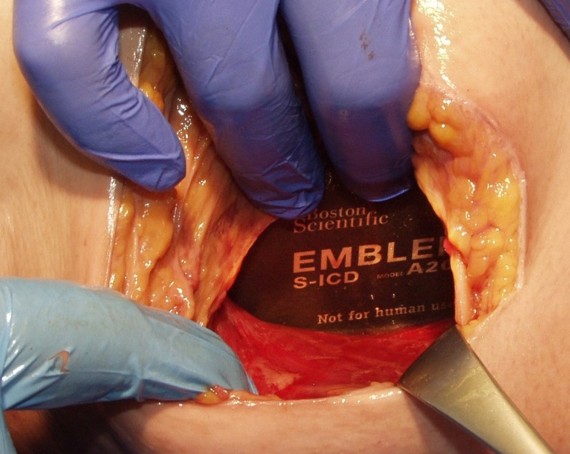 Intermuscular technique image 2