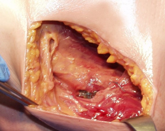 Intermuscular technique image 3
