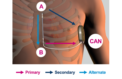 EMBLEM S-ICD sensing vectors