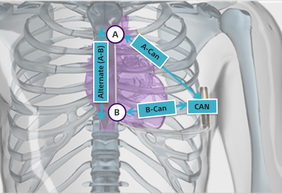 EMBLEM S-ICD sensing vectors