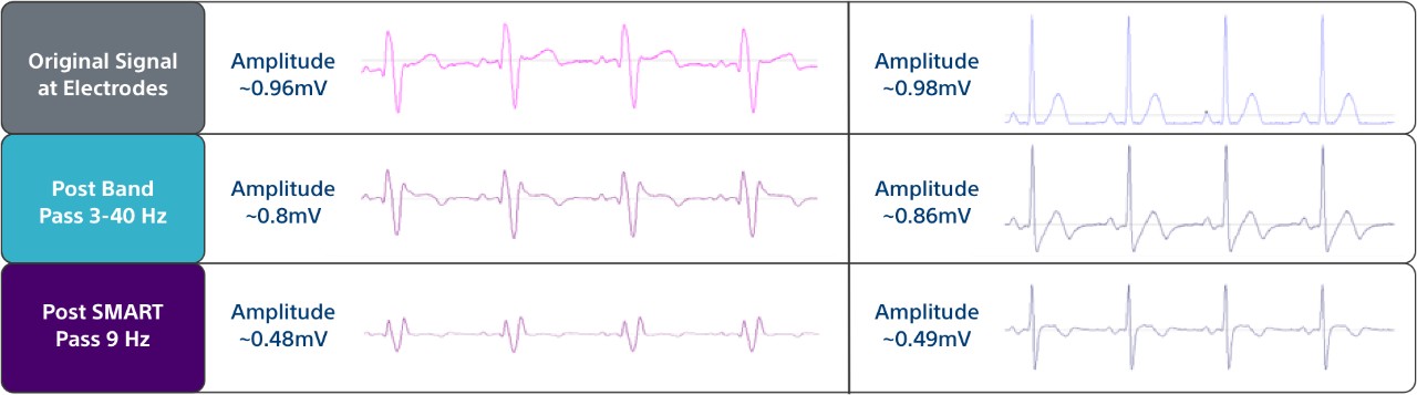 Table showing three filters the EMBLEM MRI S-ICD System uses to help minimize cardiac oversensing.