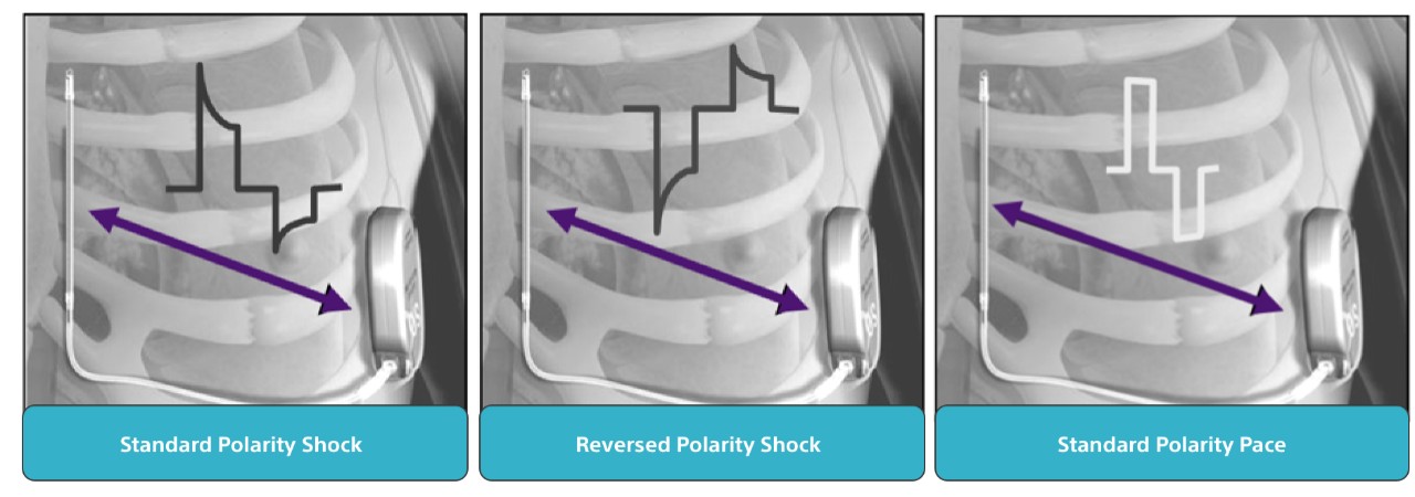 Anatomical illustration of the ribcage showing the EMBLEM MRI S-ICD System’s Standard Polarity Shock.