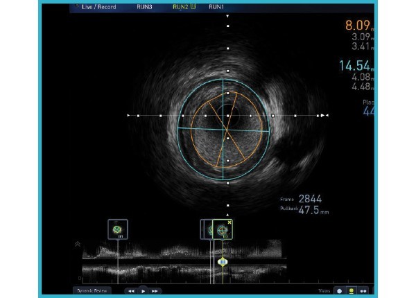 Automated Lesion Assessment (ALA™)