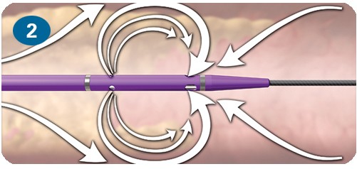 Paso 2: Mecanismo de acción del sistema de trombectomía AngioJet