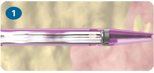 Paso 1: Mecanismo de acción del sistema de trombectomía AngioJet