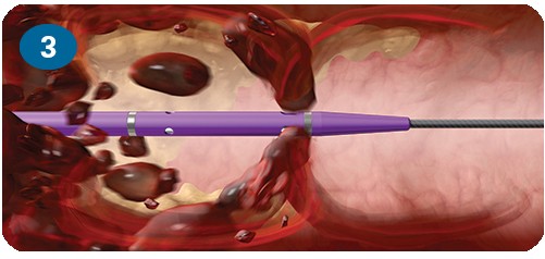 Paso 3: Mecanismo de acción del sistema de trombectomía AngioJet