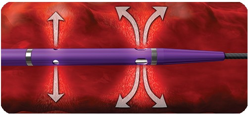 Paso 4: Mecanismo de acción del sistema de trombectomía AngioJet