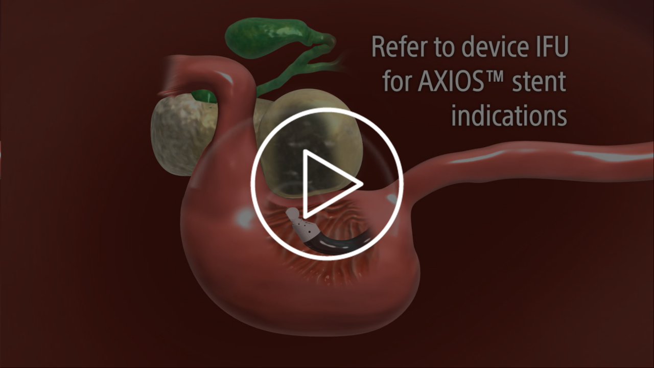 AXIOS™ stent placement with EUS 3D animation.