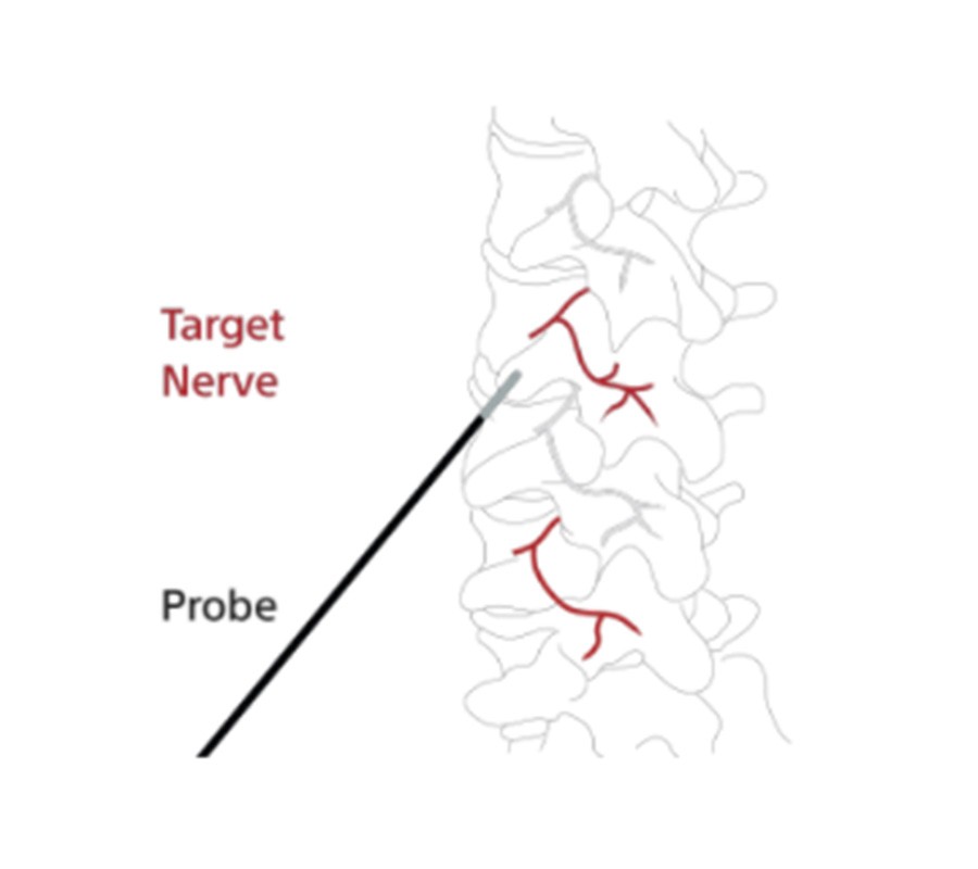 RF target nerve