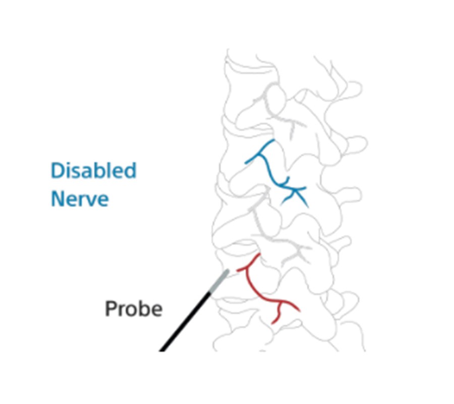 RF Disable nerve