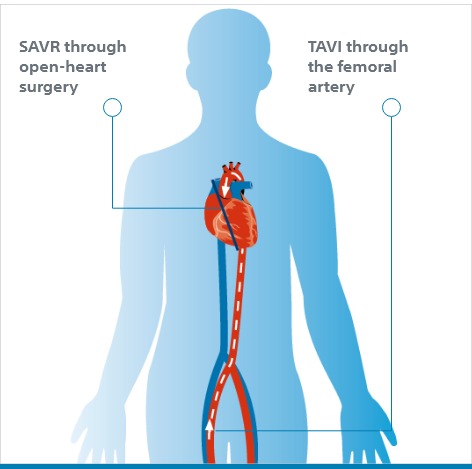 TAVI and the associated risk of Stroke.