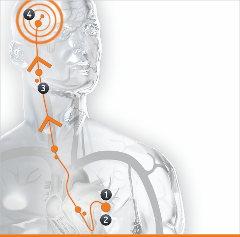 Atrial Fibrillation and the associated risk of Stroke.