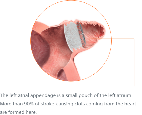 The left atrial appendage is a small pouch of the left atrium. More than 90% of stroke-causing clots coming from the heart are formed here.