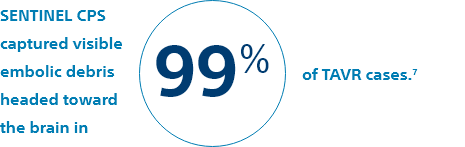 SENTINEL CPS captured visible embolic debris headed toward  the brain in 99% of TAVR cases.