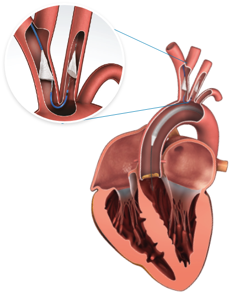 How the SENTINEL Cerebral Protection System Works