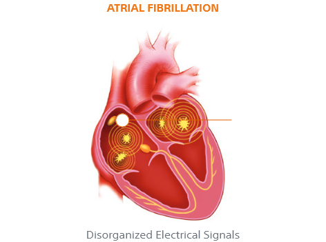 Heart with atrial fibrillation
