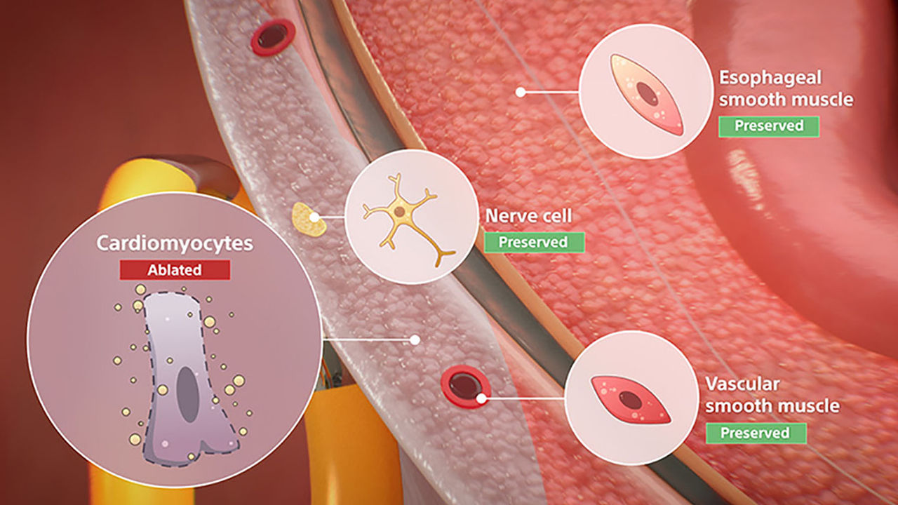 Medical illustration of cardiac ablation selectively destroying cardiomyocytes while preserving nerves and smooth muscle.