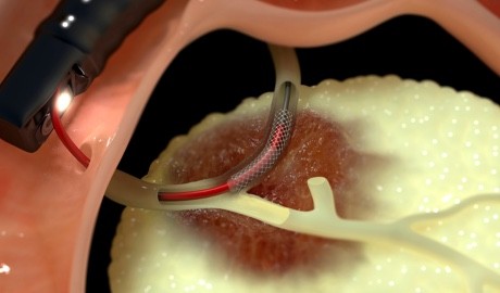 Habib™ EndoHPB: Ablation of biliary and pancreatic tumours via ERCP