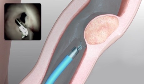 Direct visualization to diagnosis and treat complex biliary strictures and stones