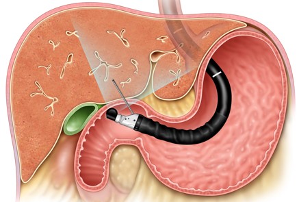 FNB for EUS-guided liver biopsy clinical education and training