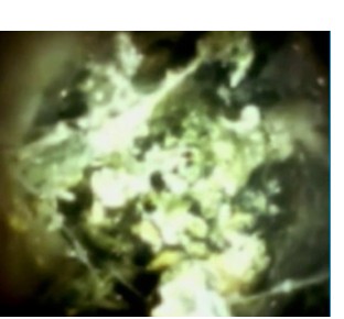 Difficult biliary stone clearance options