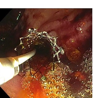 Laser Cut Biliary Metal Stent treats difficult distal CBD stricture