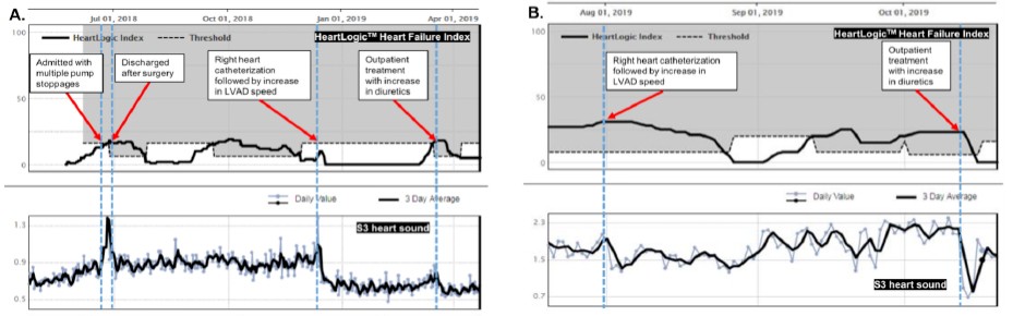 HeartLogic and S3 heart sound trends of five HeartLogic alerts occurred in two LVAD patients