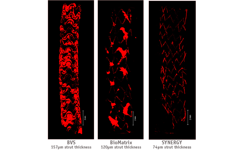 Reduced Thrombogenicity with the SYNERGY Stent