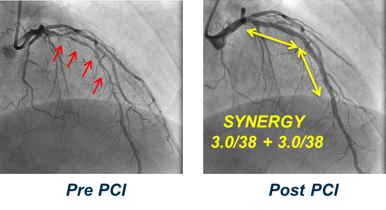 Pre- and Post-PCI images