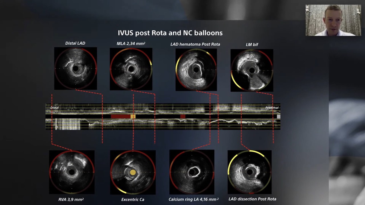 IVUS-guided Rota-Cut  case of a severely calcified lesion