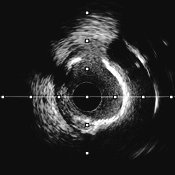 IVUS-guided assessment of lesion severity, characterizing plaque morphology