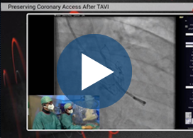 Preserving Coronary Access After TAVI