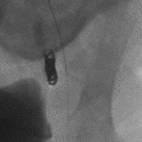 Embold Fibered Coil shown in left internal iliac artery