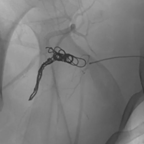 Ruby Standard Coil shown  in right subclavian medial