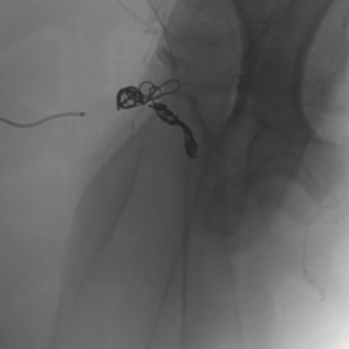 Embold Fibered Coil shown  in left subclavian medial