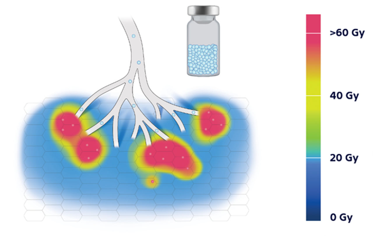 Higher RPM and fewer spheres results in more healthy tissue spared