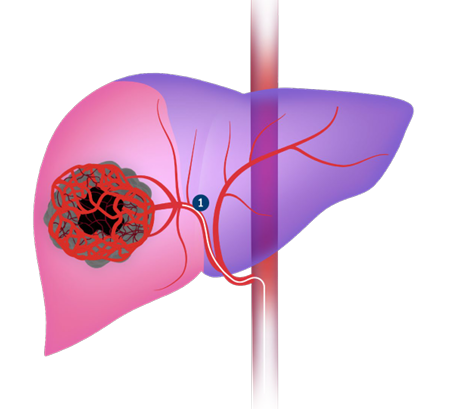 TheraSphereTM’s delivery allows for lobar administration, offering simple catheterization