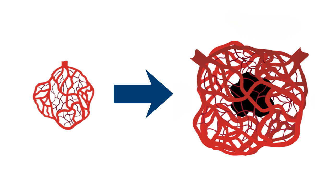 Large HCC tumours present complext internal structure, with a necrotic core and multiple feeding blood vessels.
