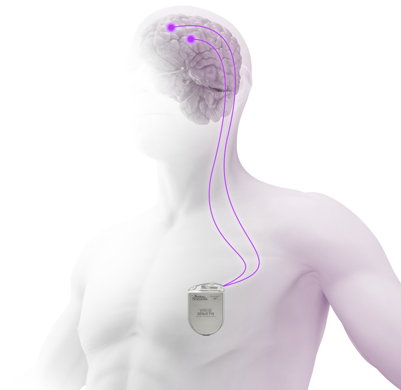 Deep Brain Stimulation DBS Boston Scientific Deep Brain Stimulation DBS Boston Scientific